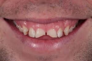 Phillip before