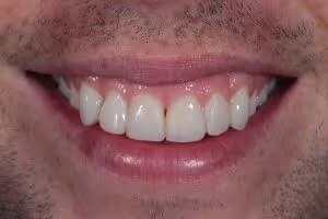 Phillip after