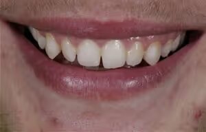 Tyler before