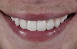 Tyler after