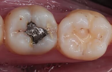 Posterior Composites before