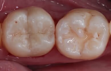 Posterior Composites after