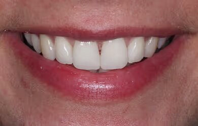 Kylie after