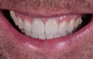 Dean after treatment