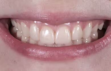 Ramona after treatment