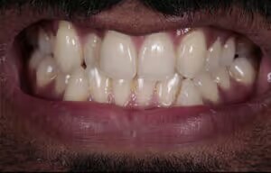Shaquil before