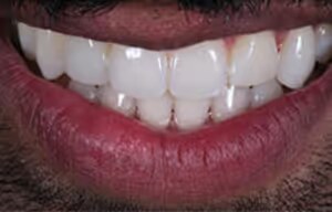 Shaquil after